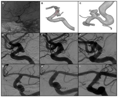 How does the recurrence-related morphology characteristics of the Pcom aneurysms correlated with hemodynamics?